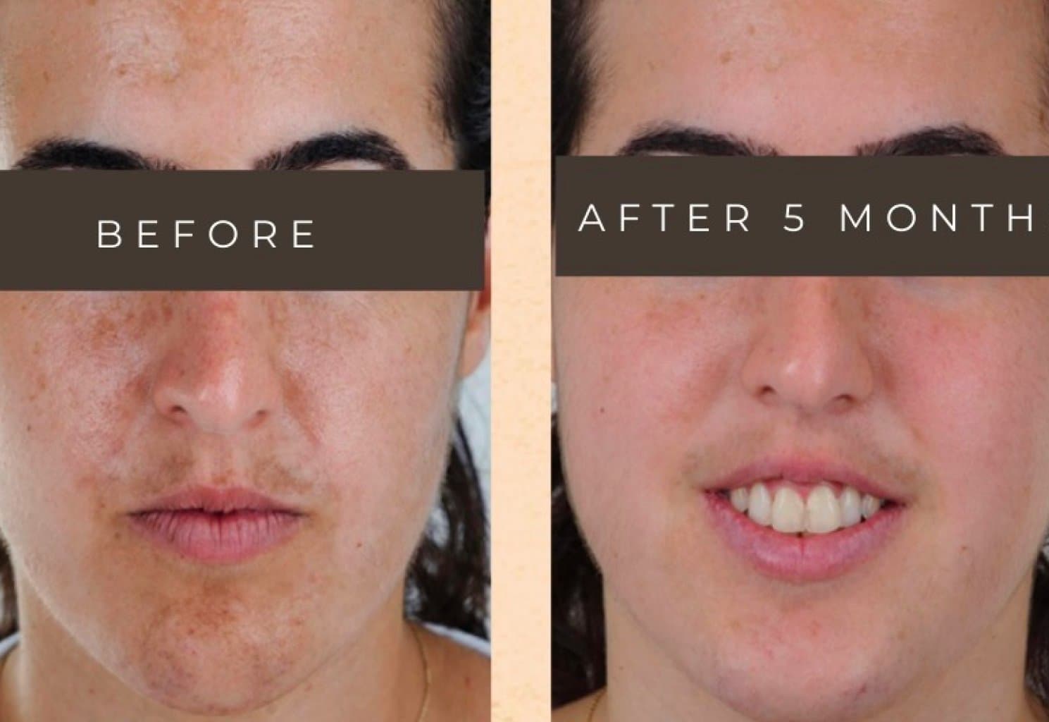 Before and after — skin treatment result