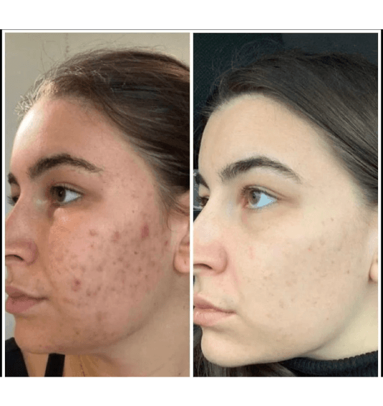 Before and after — skin treatment result