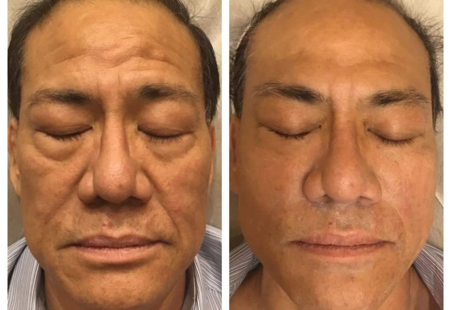 Before and after — skin treatment result