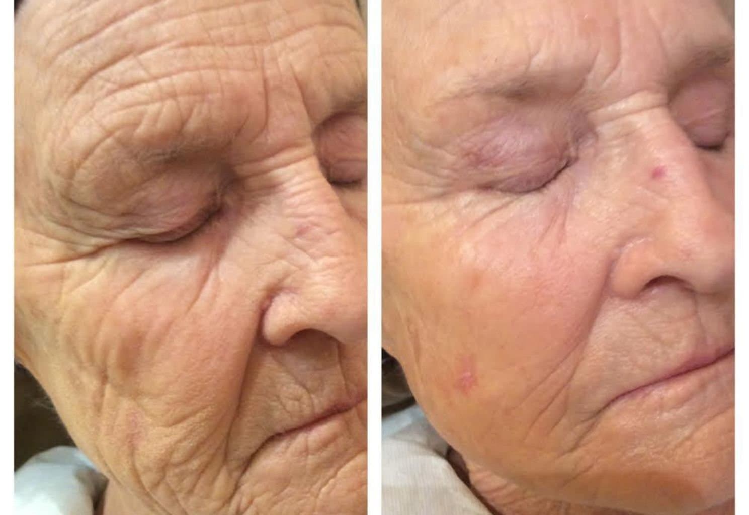 Before and after — skin treatment result