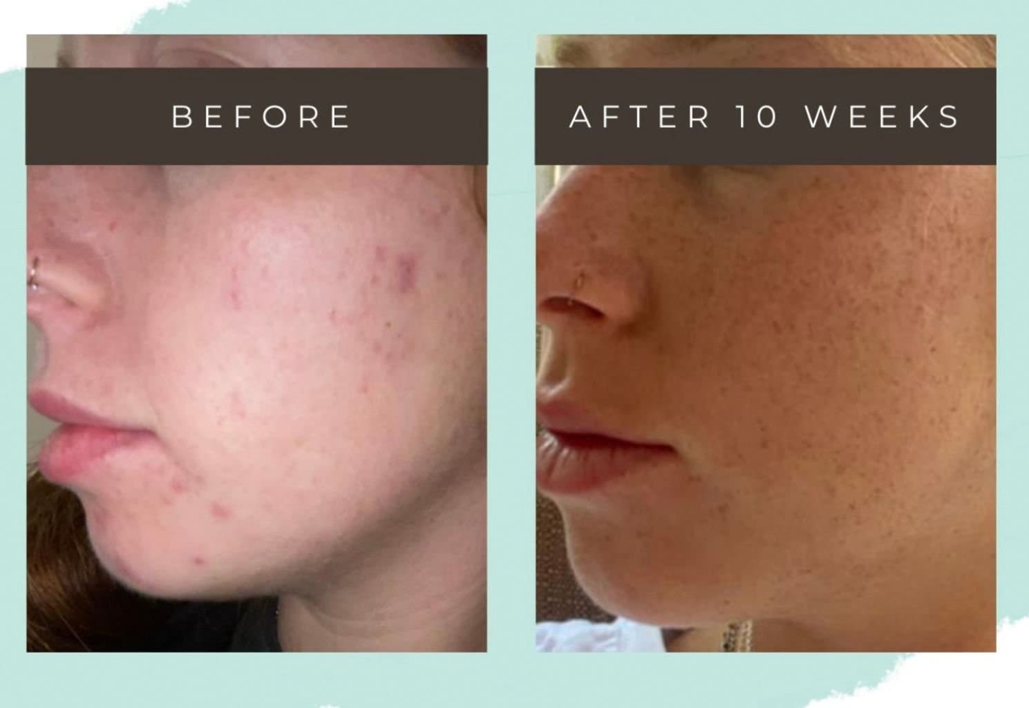 Before and after — skin treatment result