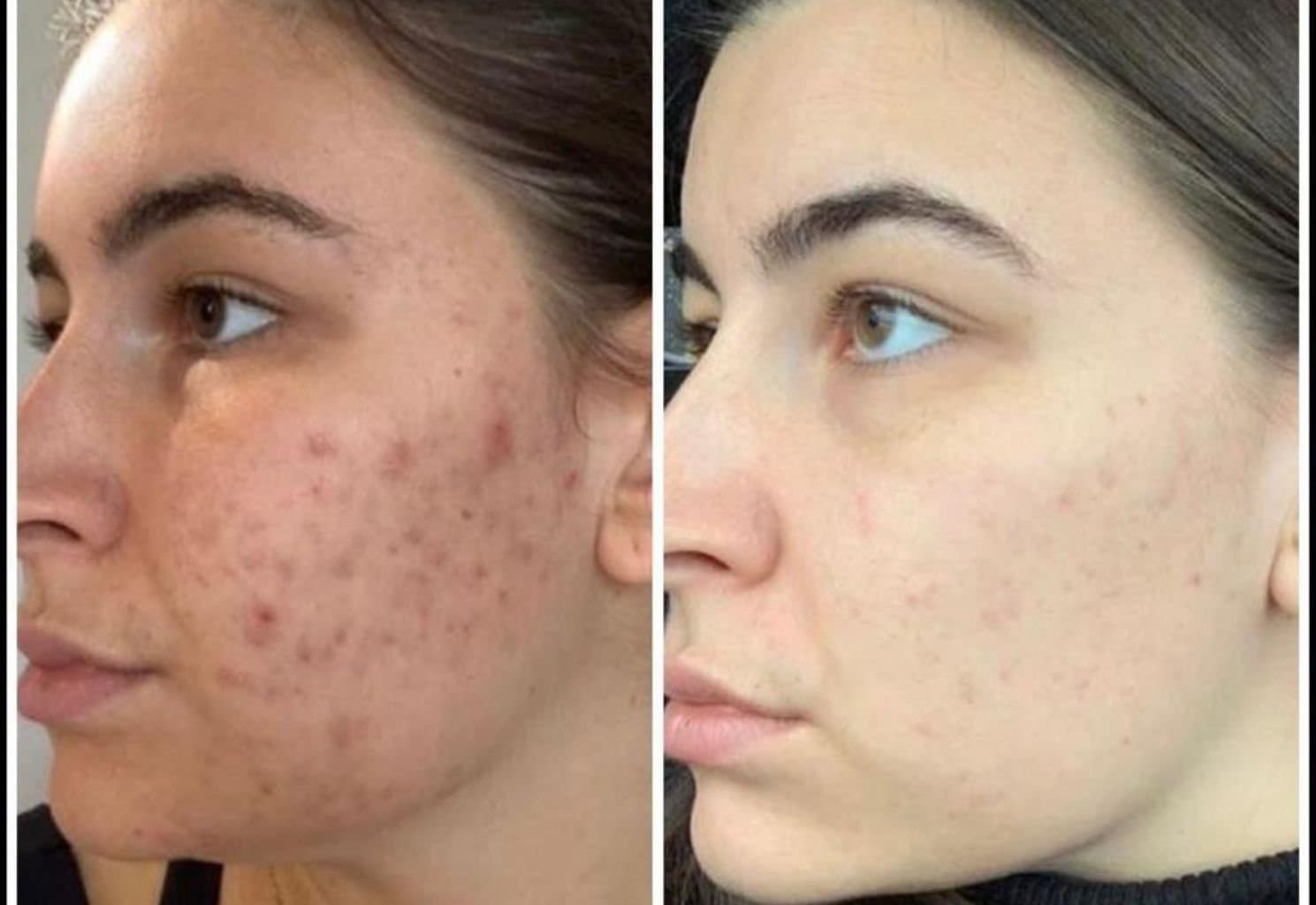Before and after — skin treatment result