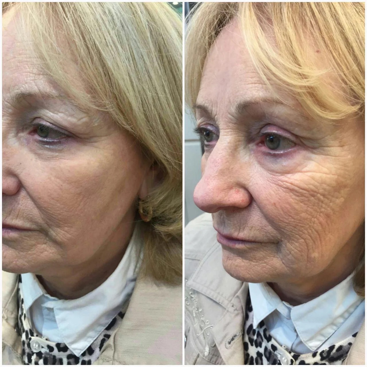 Before and after — overall facial skin rejuvenation