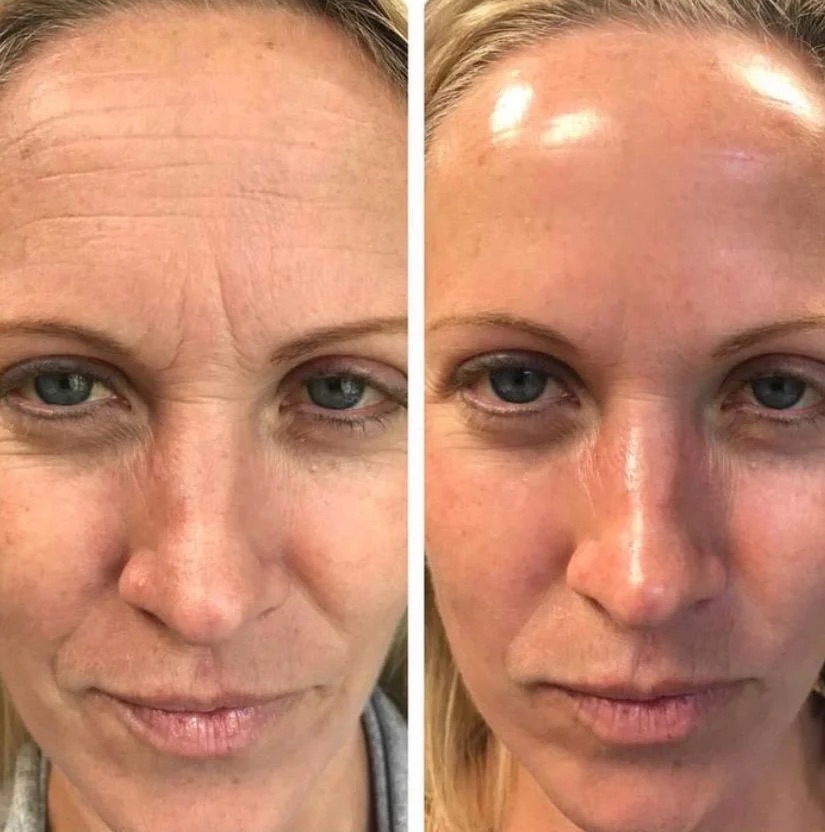 Before and after — forehead and brow lines softened with neuromodulators